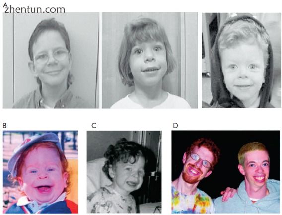 Individuals with Williams syndrome[1].jpg