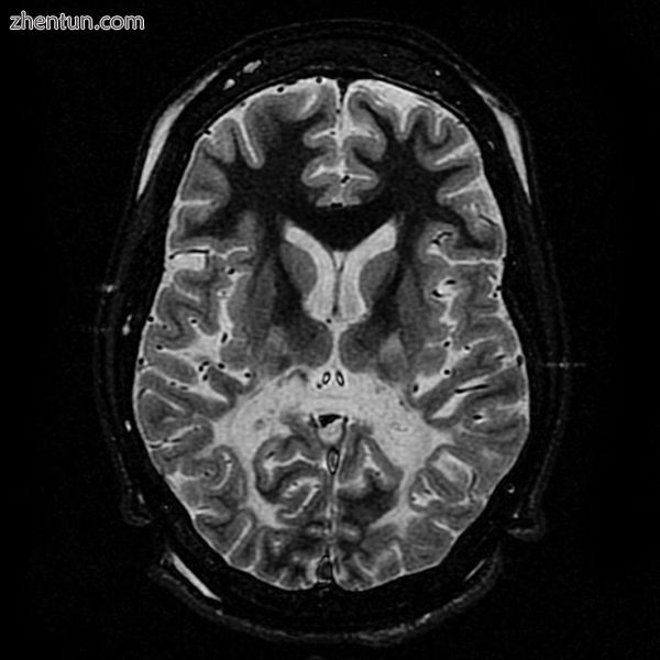 White matter, with reduced volume and increased signal intensity. The anterior w.jpg