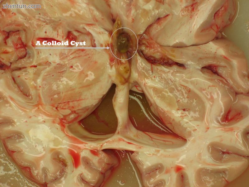 Human brain showing a colloid cyst in the third ventricle.jpg
