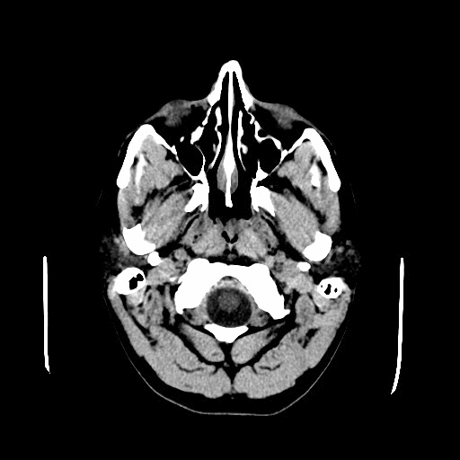 CT scan of a colloid cyst.gif