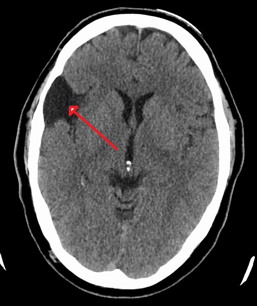 A CT scan of an arachnoid cyst.png