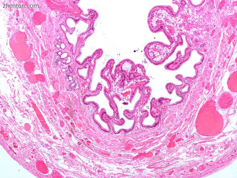 Micrograph of cholesterolosis of the gallbladder.jpg