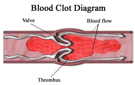 Diagram of a thrombus (blood clot) that has blocked a blood vessel valve.png