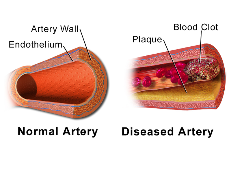 Illustration Comparing Normal Artery vs Diseased Artery with a Blood Clot.png