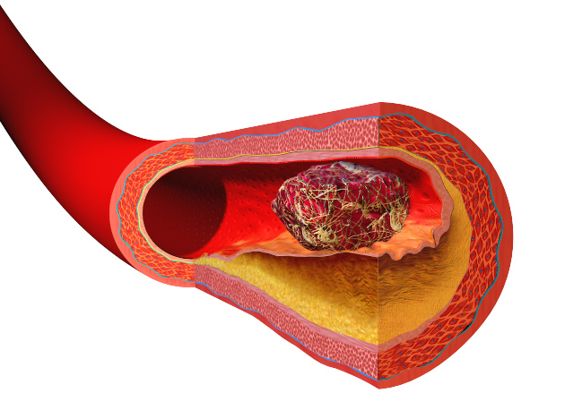 Illustration depicting thrombus formation over arterial plaque..png