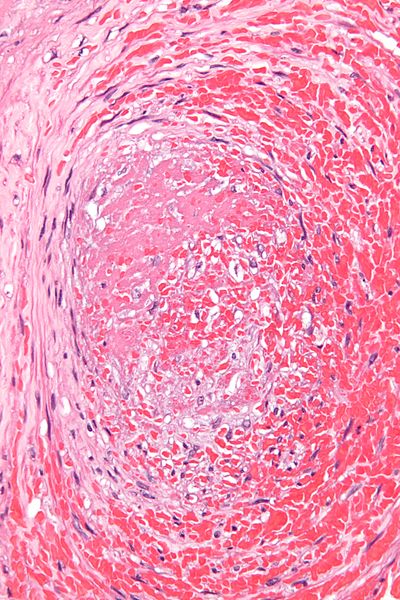 Micrograph showing a thrombus (center of image) within a blood vessel of the pla.jpg