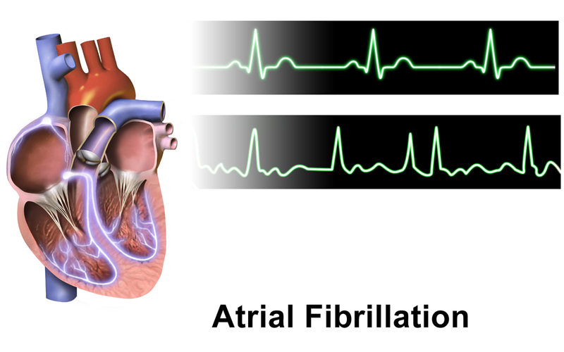 Normal rhythm tracing (top) Atrial fibrillation (bottom).png