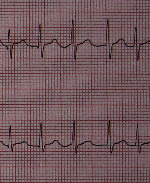 Leads V4 and V5 of an electrocardiogram showing atrial fibrillation with somewha.jpg