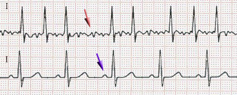 ECG of atrial fibrillation (top) and normal sinus rhythm (bottom). The purple ar.jpg
