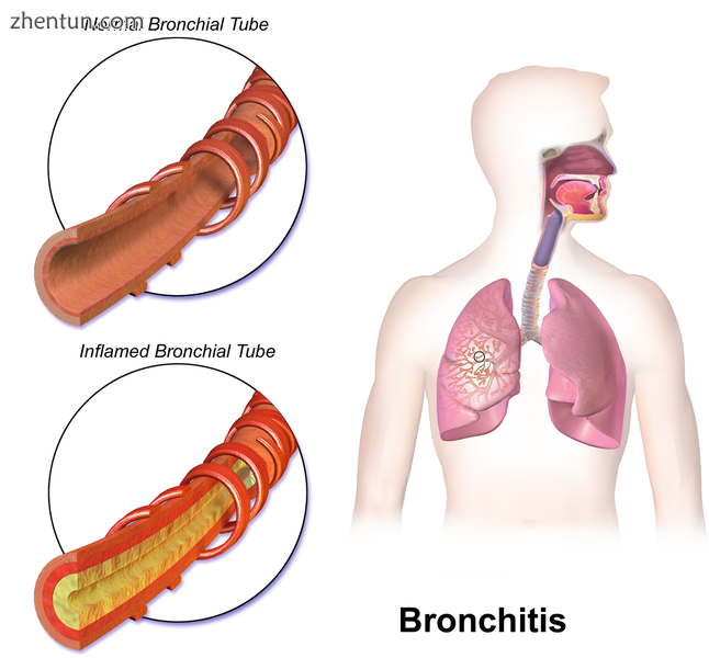 Bronchitis.png