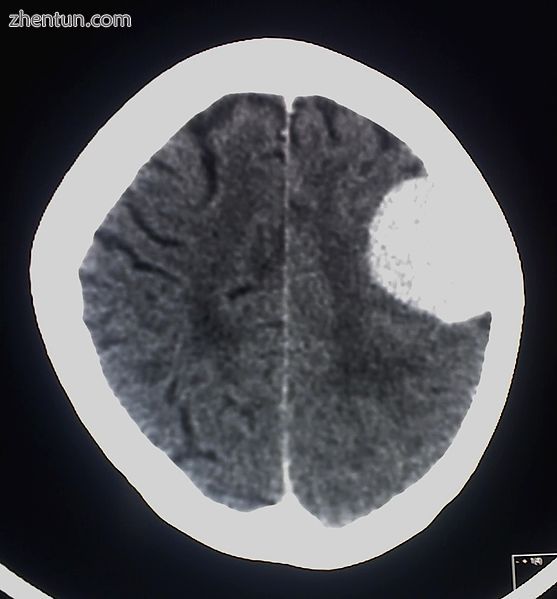 A contrast-enhanced CT scan of the brain, demonstrating the appearance of a meningioma.jpg