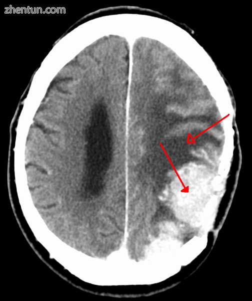 A meningioma that previously had been operated on, with surrounding edema.PNG