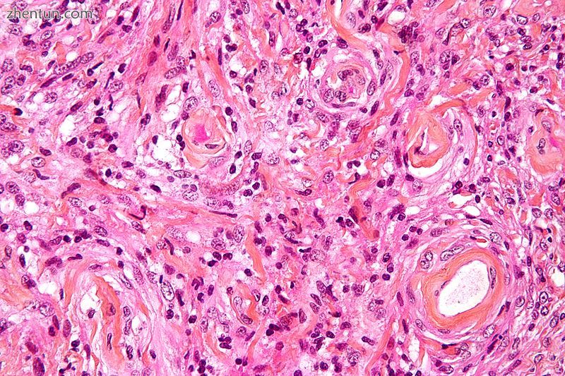 Micrograph of a meningioma showing the characteristic whorling, HPS stain.jpg