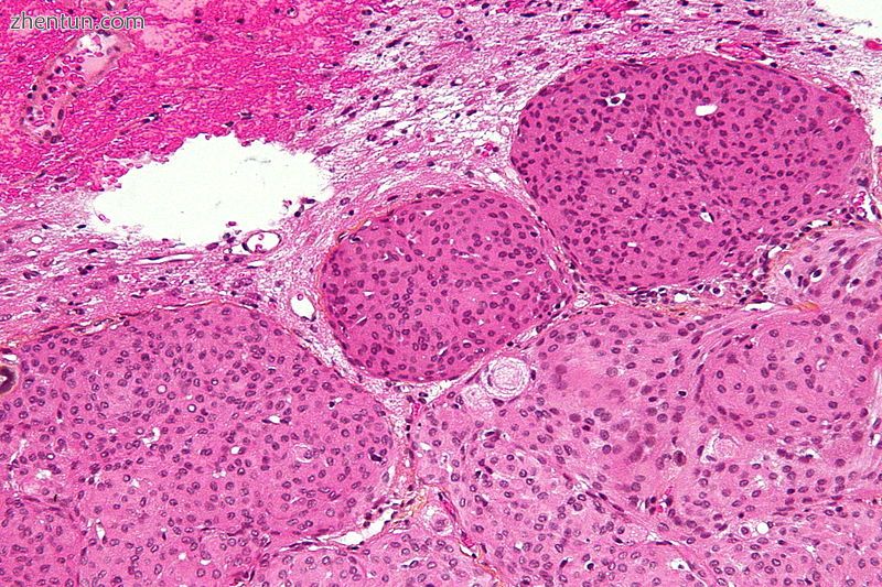 Micrograph of a meningioma with brain invasion (WHO Grade II); the tumour (b.jpg