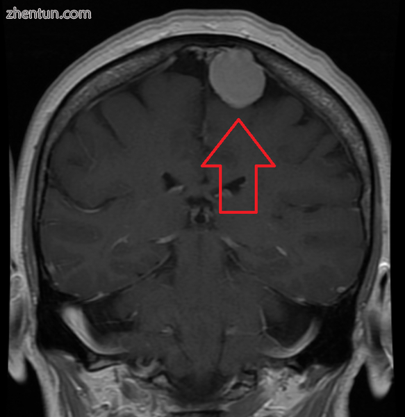 MRI image of a meningioma with contrast.png