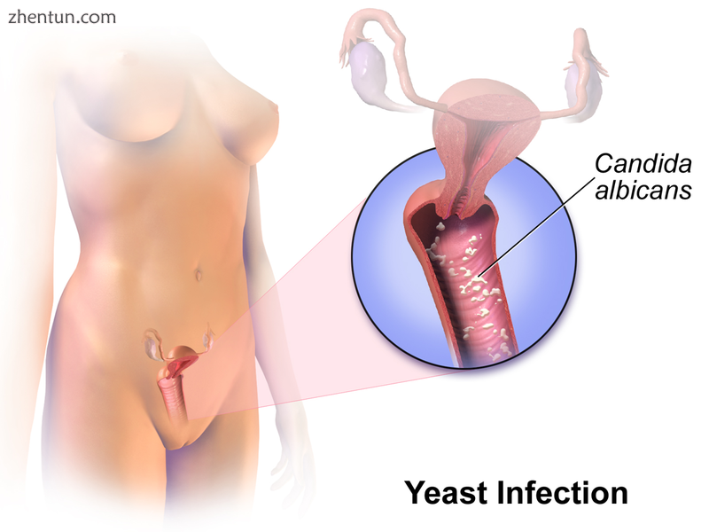 Yeast infection..png