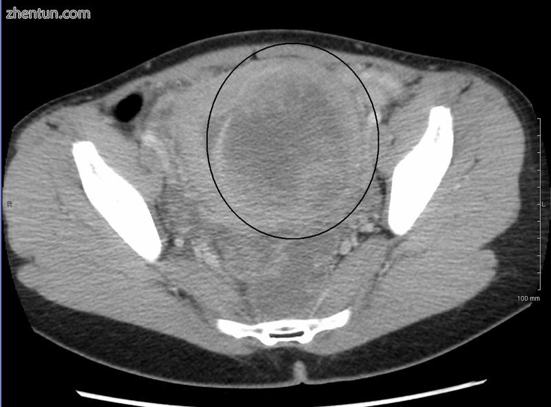 A very large (9cm) fibroid of the uterus which is causing pelvic congestion synd.png