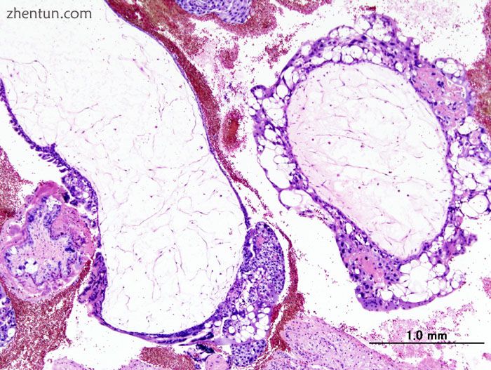 Histopathologic image of hydatidiform mole (complete type). H &amp; E stain..jpg