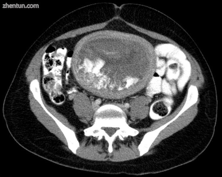 Hydatidiform mole on CT, axial view.jpg