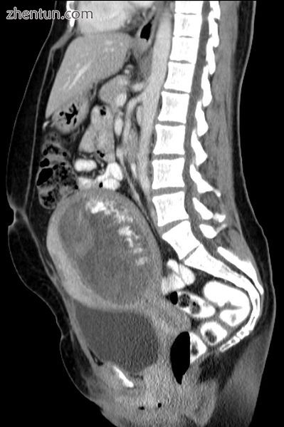 Hydatidiform mole on CT, sagittal view.jpg