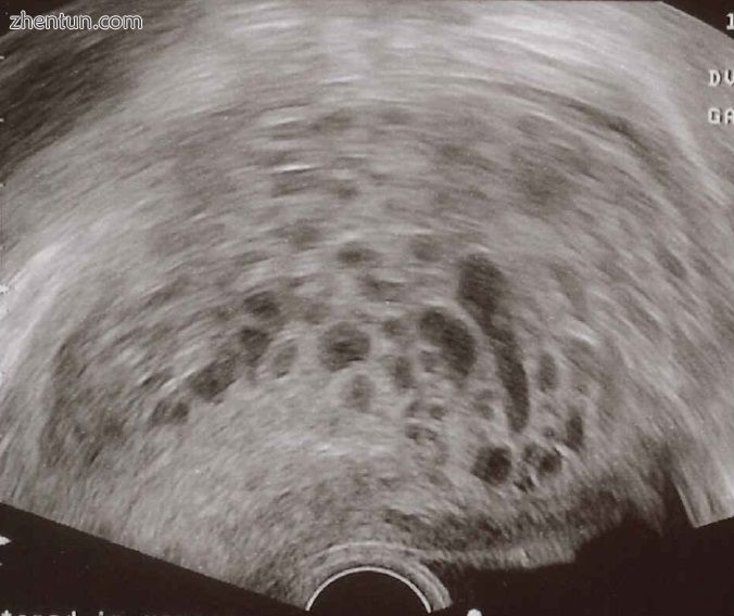Transvaginal ultrasonography showing a molar pregnancy..jpg