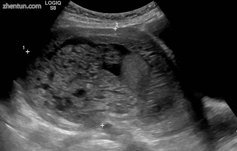 Molar pregnancy in ultrasound.jpg