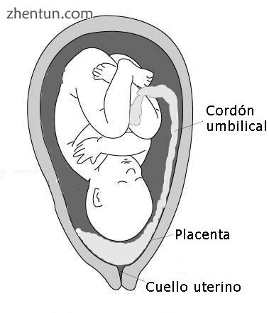 Diagram showing a placenta previa (Grade IV ).jpg
