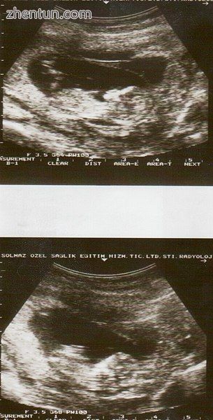 Ultrasound showing placental abruption..jpg
