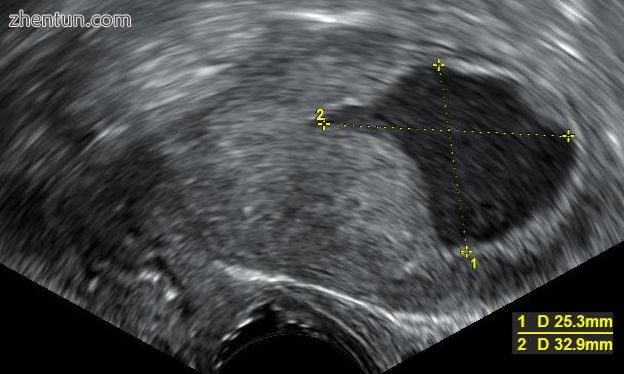 Transvaginal ultrasonography showing a uterine fluid accumulation in a postmenop.jpg