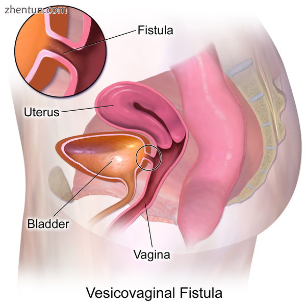 Vesicovaginal fistula.png