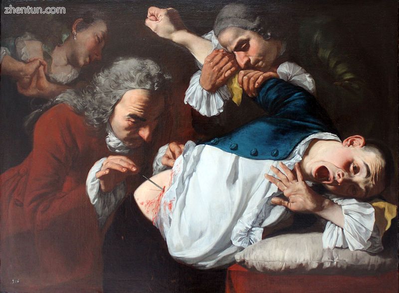 An operation in 1753, painted by Gaspare Traversi..JPG