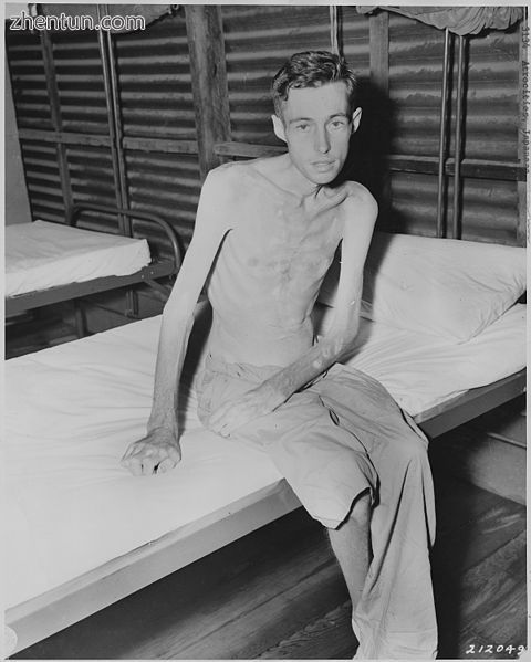 Prisoner of war exhibiting muscle loss as a result of malnutrition. Muscles may .jpg
