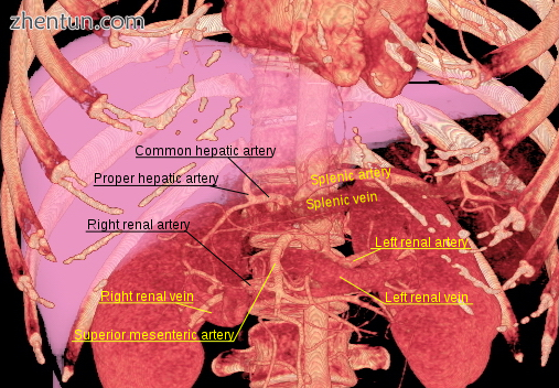 3D-rendered computed tomography, showing renal arteries and veins.png