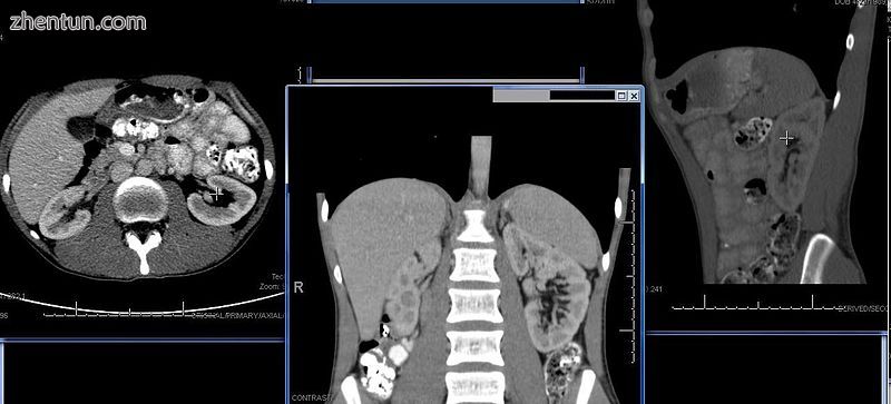 CT scan of the kidneys. Left cross section at upper abdomen level – the liver i.jpg