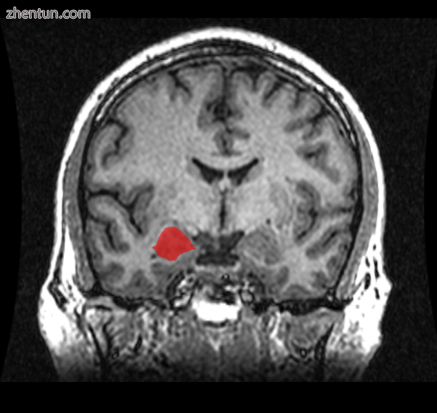 MRI coronal view of the right amygdala.png
