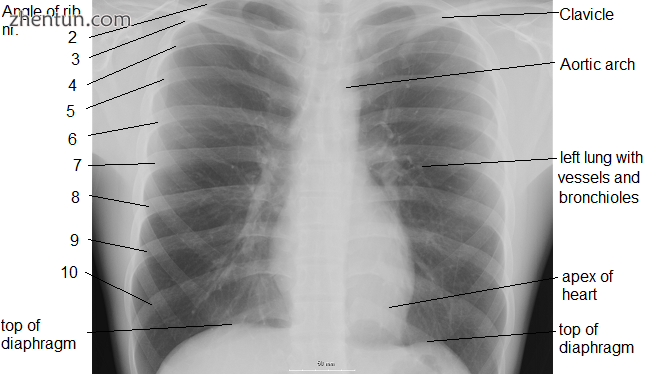 An X-ray of a human chest area, with some structures labeled.png