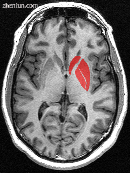 The striatum in red as seen on MRI. The striatum includes the caudate nucleus (t.png