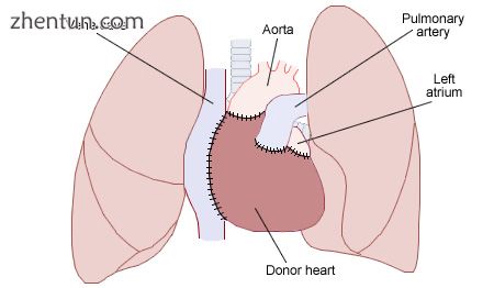Diagram illustrating the placement of a donor heart in an orthotopic procedure. .jpg