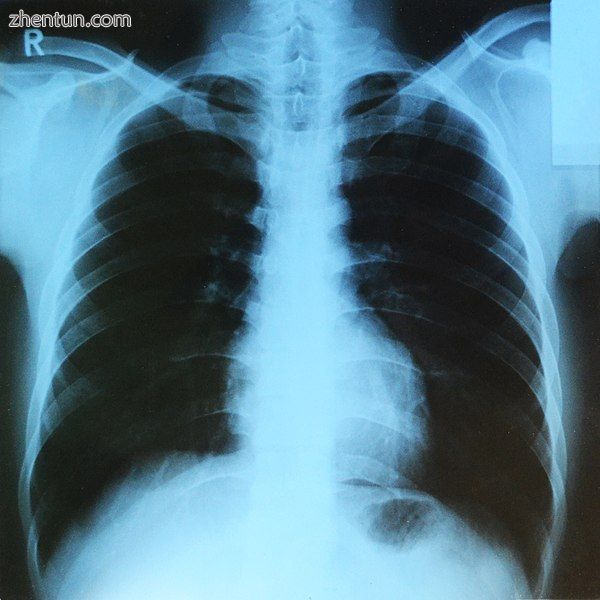 X-ray of human lungs.jpg