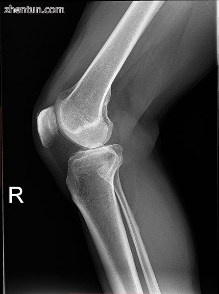Plain radiograph of the right knee.jpg