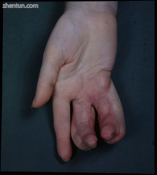 Deformity of hand due to an X-ray burn. These burns are accidents. X-rays were n.jpg