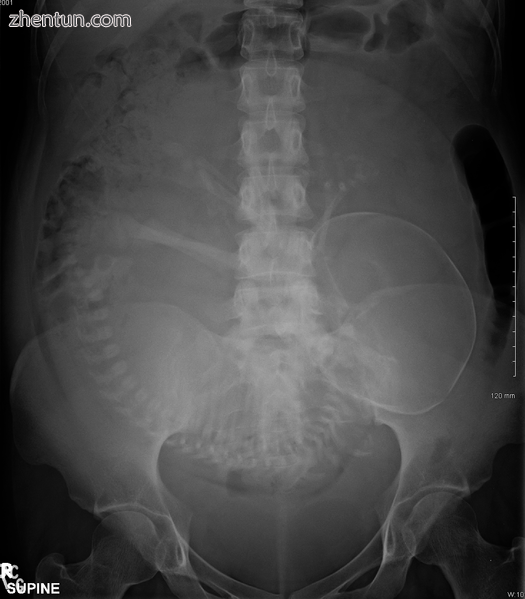 Abdominal radiograph of a pregnant woman, a procedure that should be performed o.png