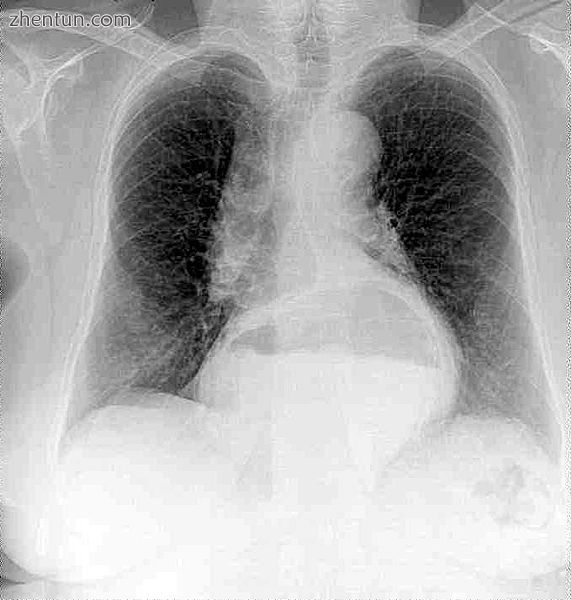 A chest radiograph of a female, demonstrating a hiatal hernia.jpg