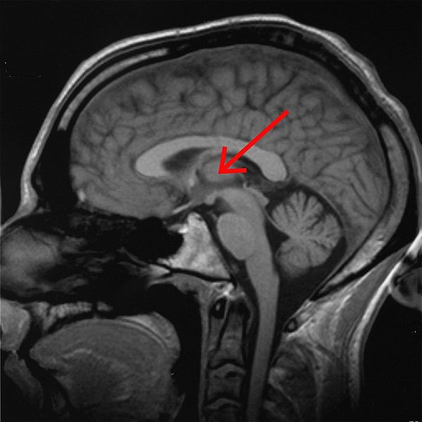 Thalamus marked (MRI cross-section).jpg