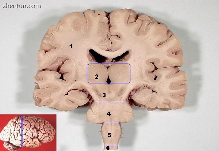 The midbrain, pons, and medulla oblongata are labelled on this coronal section o.jpg