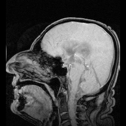 MRI showing flow of CSF.gif