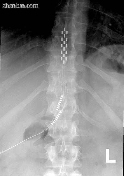 Anterior view X-ray of a spinal cord stimulator (SCS) implanted in the thoracic spine.jpg