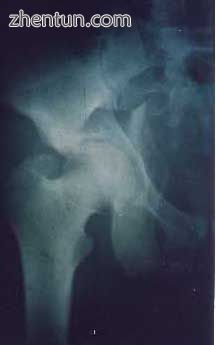 X-ray of T shape fracture.jpg
