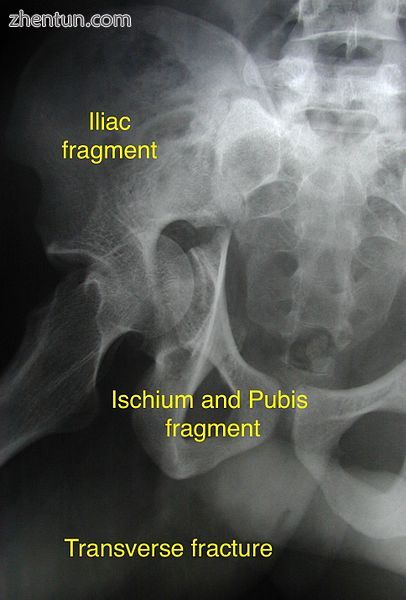 Transverse fracture showing upper iliac fragment, lower ischial and pubic fragment.jpg