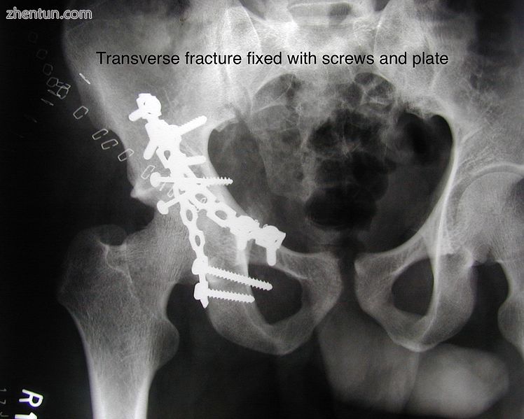 Transverse fracture fixed with screws and plate.jpg